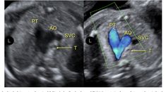 Aortic Arch, Coarctation Of The Aorta