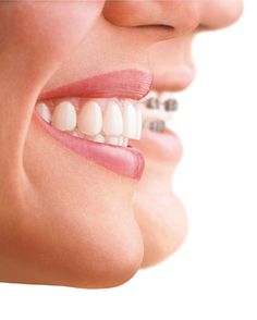 💝 Dental Post, Dental Wallpaper, Invisalign Braces, Dental Posts