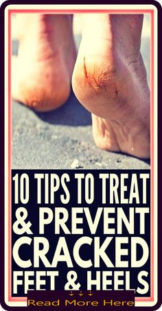 This Simple Home Remedy  - Cures Cracked Heels, Corns and Calluses in 10 Days by Aleksandar Stefanovski | This newsletter was created with Smore, an online tool for creating beautiful newsletters for educators, businesses and more Homemade Foot Soaks, Unhealthy Diet, Cracked Skin, Healthy Beauty, Simple Home