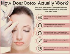 Botox Advertising Ideas, Botox Education, Injection Aesthetic, Botox Benefits, Botox Tips, Injector Nurse, Botox Forehead