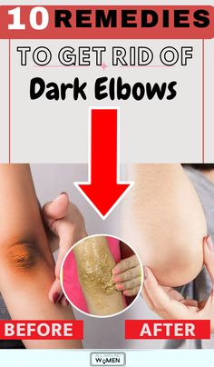 10 Remedies To Get Rid Of Dark Elbow, dark elbow, skin care Lighten Dark Elbows, Body Hyperpigmentation, Lighten Dark Knees, Dark Elbows And Knees, Sunburn Peeling, Dark Knees, Dark Elbows, Human Body Temperature, Natural Face Care