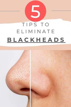 Eye Wrinkle Cream, Beauty Tips And Tricks, Natural Health Care, Get Rid Of Blackheads, Large Pores, Beauty Advice