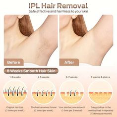 Natural Hair Removal Remedies, Remove Skin Tags Naturally, Permanent Hair Removal, Ipl Laser Hair Removal, Underarm Hair Removal, Laser Hair Removal Device, At Home Hair Removal, Ipl Laser, Hair Removal Device