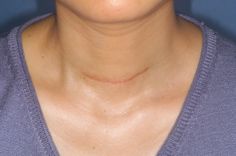 Neck Scar Reference, Neck Scar, Scar Face, Thyroid Surgery, Tattoo Over Scar, Scar Tattoo, Sun Exposure, Famous Celebrities, Body Goals