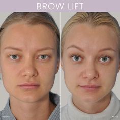 Brow Lift Before and After Eyelid Lift Before After, Latisse Before And After, Thread Lift Face Before And After, Botox Eyebrow Lift Before And After, Botox Brow Lift Before And After