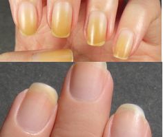 How To Clean Yellow Nails, Pitted Nails, Stained Nails, Nail Whitening, Hydrogen Peroxide, Yellow Nails