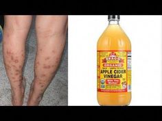 Apple cider vinegar is a solution which has high properties of amino acids, mineral salts, and acetic acid. It also has a wide range of vitamins. These prope... Dark Spots On Legs, Apple Cider Vinegar For Skin, Varicose Vein Remedy, Spots On Legs, Underarm Hair Removal, Dark Underarms, Brown Spots On Face, Dark Spots On Skin, Remove Dark Spots