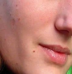 Homemade Skincare Face, What Are Skin Tags, Skin Tags Removal, Dry Skin Routine, Scaly Skin