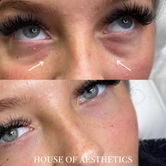 Trough Filler Before After, Eye Bag Filler, Eye Trough Filler, Tear Through Filler Before And After, Eye Trough Filler Before And After, Tear Trough Makeup, Tear Trough Filler Before After, Under Eye Filler Before And After, Fillers Before And After