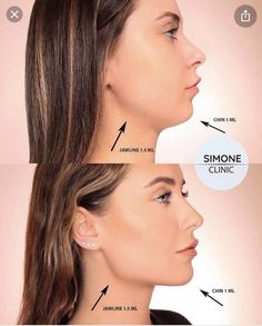 Chin Augmentation