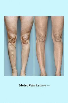 How To Get Rid Of Varicose Veins, Varicose Vein Ulcers, Essential Oils For Varicose Veins, Varicose Veins Essential Oils, Varicose Vein Cream, Cider, Aloe Vera