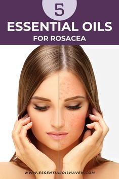 Struggling with rosacea? 🌿 Discover the top 5 essential oils known for their calming and soothing effects on rosacea-prone skin. From anti-inflammatory chamomile to redness-reducing rose, these oils can help manage symptoms naturally. Plus, get easy recipes to incorporate them into your skincare routine for a clearer, more comfortable complexion. 🌸✨ #RosaceaRelief #EssentialOils Soothing Recipes, German Chamomile Essential Oil, Cypress Essential Oil, Chamomile Essential Oil