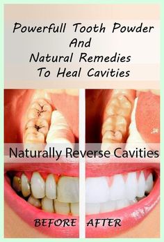 Thanks a million. Amazing info! Heal Cavities Naturally, Reverse Cavities, Tooth Powder, Clipuri Video, Diy Health