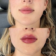 a woman's face before and after lip fillers