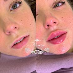 Nose Job And Lip Fillers, Lip Fillers On Small Lips, Lip Fillers 2ml, Lip Injections Natural, Lip Implants Before And After, Russian Style Lip Fillers, 1.5 Ml Lip Filler