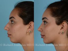 Rhinoplasty Before And After Front View, Nose Surgery Before And After, Chin Implant Before And After, Noise Job, Chin Fillers Before After, Lipo Before And After