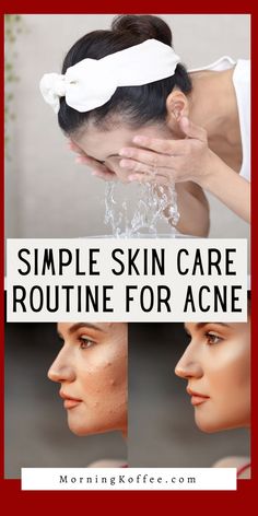 If you're struggling with acne, implementing a solid skincare routine may be the key to clearer skin. To get started, here are five simple steps you can take to help combat breakouts. Steps Skincare Routine, Clear Flawless Skin, Skin Care Routine For Acne, Skincare Routine For Acne, Simple Skin Care Routine, Steps Skincare, Simple Skin Care, Dry Skincare