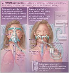 the procedure is performed to treat and prevent breathing