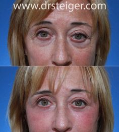 Facial Exercises For Men, Face Rejuvenation, Face Lift Exercises, Eye Wrinkles, Natural Face Lift, Fat Grafting, Beauty Procedures, Dark Rings, Face Yoga Exercises