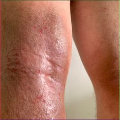 Eczema SOS: Getting on top of eczema flare-ups When an eczema flare rears its head,... Laser Acne Scar Removal, Peroxide For Acne, Acne Scar Removal, Holistic Beauty, Dry Skin Care, Allergic Reaction, Skin Tips, Skin Health, Battlefield