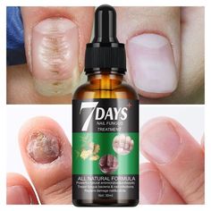 Extra Strength Toenail & Fingernail Drops Nail Care For Thick Damaged & Discolored Nails 2 Pack30ml Features: STOPS NAIL PROBLEMS IN ITS TRACKS: It clears up discolored, brittle and thick toenails and fingernails. Improves the appearance of damaged toenails and finger nails, as soon as possible, even when everything else has not worked. Plus it supports and the toenail and fingernail as it grows out looking normal and clear until the damaged part is totally . EXTRA-STRENGTH BIO-FORMULA: New and Damaged Nail Beds, Hack For Toe Separator Nail Polish, Ripped Nail Bed Repair, Thick Nail Polish Remedy, Fingernail Health, Toenail Fungal Infection, Nails Care, Nail Problems, Nail Infection