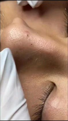 Black Head Removal Video Nose, Black Heads Removal Video, Healthy Skin Care Routine, Zit Popping Videos, Pimples Remedies, Prevent Pimples, How To Get Rid Of Pimples, Natural Sleep Remedies