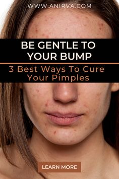 To Pop or Not to Pop (Pimples)...That is the Question...Seeing a big, red pimple on your face will surely drive you crazy. While it may be tempting to pop it, it’s not recommended. A lot of experts are actually against it, including aesthetician Danuta Mieloch. In her interview with Teen Vogue, she expressed that it can “spread bacteria and cause inflammation.” As such, doi Pimple Under The Skin, Redness Pimple, Blind Pimple, Pimples Under The Skin, Warm Compress, Pimples Remedies, Prevent Pimples, Acne Skincare Routine, Tips Skincare