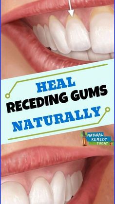 Reverse Receding Gums, Swollen Gum, Gum Recession, Loose Tooth, Dental Problems