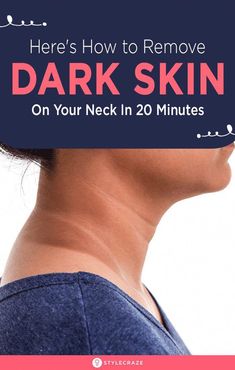 Dark Skin Around Neck, Dark Neck Remedies, Skin Lightening Diy, Dark Neck, Blind Pimple, Pimples Under The Skin, Skin Darkening, Tan Removal, Skin Shine