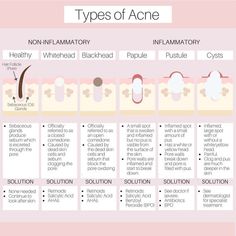 Acne Types, Different Types Of Acne, Acne Treatments, Types Of Acne, Skin Pores, Skin Skincare