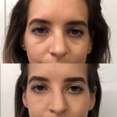 Under Eye Prp Before And After, Undereye Fillers Before And After, Eye Surgery Before And After, Tear Through Filler Before And After, Prp Undereye Before And After, Eye Fillers Before And After, Eye Trough Filler Before And After, Filler Under Eyes Before And After, Under Eye Dark Circles Makeup