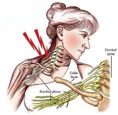 Arm Numbness, Brachial Plexus, Cervical Pain, Neck Injury, Yoga For Balance, Neck And Shoulder Pain, Medical Anatomy, Relieve Back Pain, Neck And Back Pain