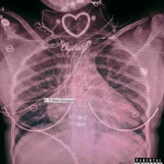 an x - ray image shows the chest and ribs, with words written on it