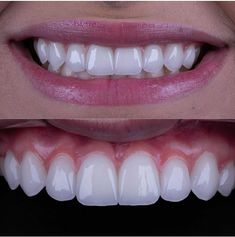 Crown Teeth, Perfect Smile Teeth, Face Plastic Surgery, Cosmetic Dentistry Veneers, Teeth Aesthetic, Cosmetic Dentistry Procedures, Pretty Teeth, Veneers Teeth, Beautiful Teeth