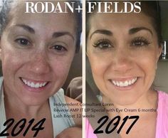 Check out Loren's STUNNING results using Rodan + Fields Award Winning skincare.   Did you know that Preferred Customers get free shipping, a 10% discount, and early access to new products and promotions? Multifunction Eye Cream, Amp Md Roller, Reverse Aging Skin, Rodan And Fields Reverse, Diy Eye Cream, Bad Skin, Aging Backwards, Old Pics