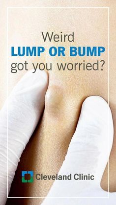 Do You have got A Lump On your Neck, Back, Or Behind Your Ear? That is What It Means #LumpUnderSkinOnBack #LumpUnderSkinOnFace #LumpUnderSkinOnNeck #PimplesOnNeck #SmallLumpOnNeck #SmallBumpsOnFace Serious Illness, Cleveland Clinic, Doctor Visit, Bump