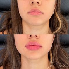 Lip Filler Before And After Round Lips, Lip Filler Bottom Lip Bigger, Lip Filler Round Lips, Small Round Lips, Lip Filler On Small Mouth, Angelina Jolie Lip Filler, Pout Lip Filler, Natural Lip Fillers 1ml, Round Lips Filler