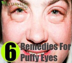 Swollen Eyelids Remedy, Swollen Eye Remedies, Allergy Eyes, Under Eye Puffiness