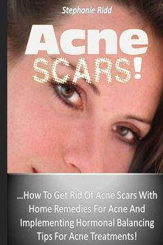 Acne Scars!: How To Get Rid Of Acne Scars With Home Remedies For Acne And Implementing Hormonal Balancing Tips For Acne Treatments! by Stephanie Ridd, 9781530439416, available at LibroWorld.com. Fast Delivery. 100% Safe Payment. Worldwide Delivery. Tips For Acne, Cystic Acne Remedies, Remedies For Acne, Blind Pimple, Pimples Under The Skin, Acne Vulgaris, Get Rid Of Acne, Acne Treatments, Rid Of Acne