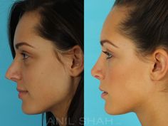 Patient 528, Rhinoplasty before and after pictures Nose Pimples, Nose Reshaping, Stubborn Acne