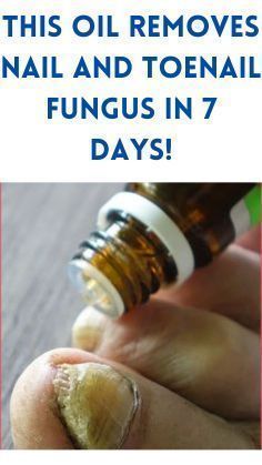 Toenail fungus is destructive to your nails and more common than you think! After trying several over the counter remedies that failed, I turned to natural remedies and finally got rid of my toe nail fungus. | summer nail 2023 | nail summer idea | nail gel 2023 | fungus treatment toenails | nail fungus cure | nail fungal infection remedies | fungal infection | nail fungus soak #summernailsideas2023 #killsnail #treatmentfungus #nailfungus #toenailfungus #fungus #fungustretment #fungustoenail Fungal Infection Remedies, Toenail Health, Toenail Fungal Infection, Nail Remedies, Toenail Fungus Remedies, Nail Fungus Remedy, Nail Infection, Fungal Nail, Ingrown Toe Nail