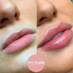 The Lip fillers treatment is also called lip augmentation treatment where dermal fillers are injected in the sensitive areas of your lips and mouth. Aesthetics Nurse, Dermal Fillers Lips, Pure Aesthetic, Lips Inspiration, Permanente Make-up, Botox Lips, Facial Fillers, Cosmetic Injectables, Facial Contouring