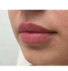 Lip Filler Reference, Pouty Upper Lip, Julie Horne Lip Filler, Natural Lip Injections Before And After, Healed Lip Filler, 2 Ml Lip Filler, Small Mouth Lip Fillers, Lip Filler Inspiration 0.5ml, Lip Shapes Filler