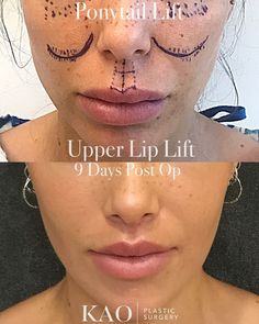 Ponytail Lift, Upper Lip Lift, Lip Surgery, Lip Lift, Facial Procedure, Nose Reshaping, Face Fillers, Upper Lip Hair