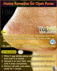 Home Remedies for Open Pores Jus Lemon, Top 10 Home Remedies, Open Pores, Large Pores, Beauty Remedies, Acne Remedies, Homemade Face Masks, Homemade Face, Skin Remedies