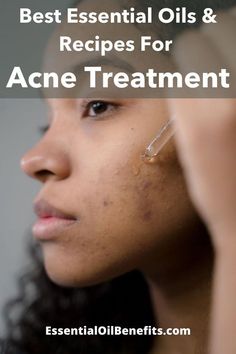 Are essential oils effective for acne treatment. Find out the best essential oils, carrier oils, blends and home remedies to deal with acne and hormonal acne. Best Essential Oil For Acne, Essential Oils For Back Acne, Diy Acne Moisturizer, Essential Oils For Pimples, Acne Essential Oil Recipe, Essential Oils For Hormonal Acne, Essential Oils Acne, Homemade Acne Remedies, Acne Essential Oil