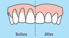 Ways To Heal, Gum Recession, Teeth Health, Receding Gums, Oil Pulling, Gum Health, Makijaż Smokey Eye, Teeth Care, Natural Health Remedies