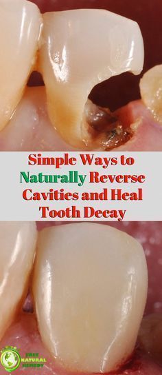 Best Way To Naturally Reverse Cavities And Heal Tooth Decay! #whitingteeth #teethwhiting #teethcare #healthyteethtips #healteethnaturally #healthygumsandteeth #teethremedies #tipsforhealthyteeth #toothdecaycure #toothproblem #gumproblems #toothdecaytreatmentathome Reverse Cavities Naturally, Rotting Teeth, Teeth Decay, Teeth Remedies, Reverse Cavities, Tooth Decay Remedies, Microscopic Organisms, Dental Health Care, Bad Teeth