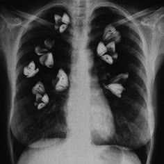 an x - ray shows the chest and lungs