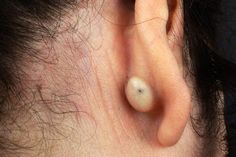 Skin lumps and bumps can pop up from time to time. Browse this WebMD slide show to learn what’s normal and what to show a doctor. Lump Behind Ear, Black Head Removal, Ear Pimple, Skin Tags On Face, Satisfying Zit Popping Videos, Honey Face Cleanser, Blackheads On Face, Remove Skin Tags Naturally